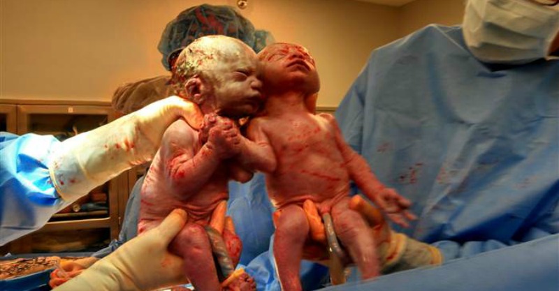 Twins born holding hands are as inseparable as ever