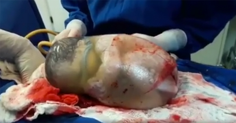 WATCH: Fascinating video of sweet cocooned baby born in amniotic sac