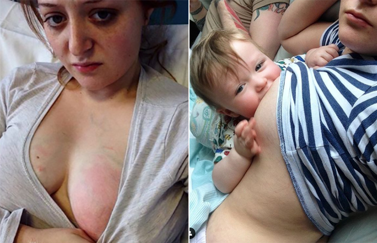 Mum's raw mastitis photo reminds us breastfeeding mums need more
